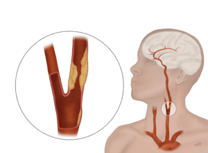 Carotid-Artery-Disease