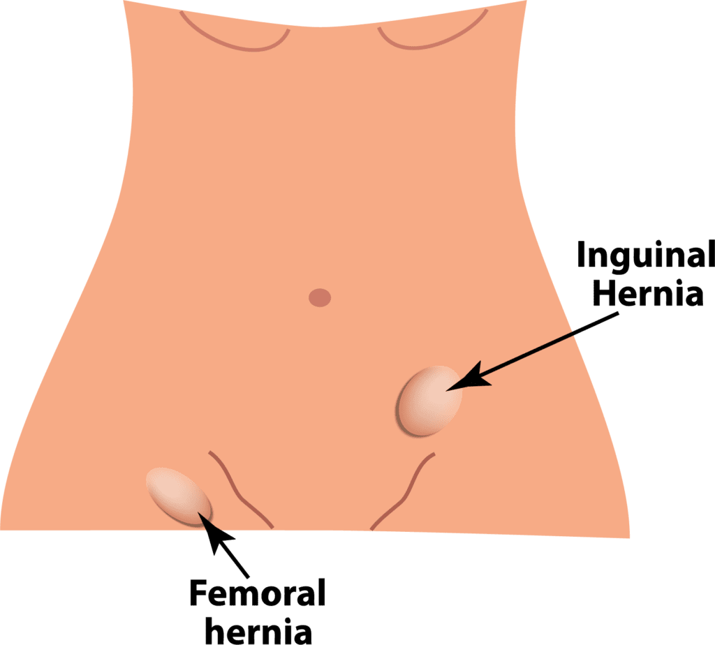 groin hernias Hernia Center - Brown Surgical Associates - hernia treatment near me - hernia surgeon near me - hernia surgeon RI - hernia care rhode island
