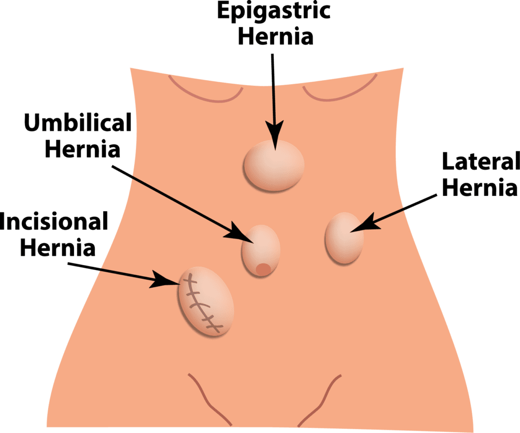 ventral hernias Hernia Center - Brown Surgical Associates - hernia treatment near me - hernia surgeon near me - hernia surgeon RI - hernia care rhode island