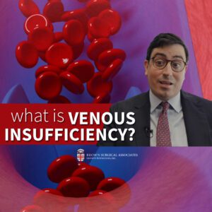Dr. Anthony Meena explains venous insufficiency